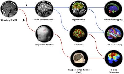 MRI-Based Geometric Modeling for Personalized Transcranial Magnetic Stimulation in Age-Related Neurodegenerative Diseases